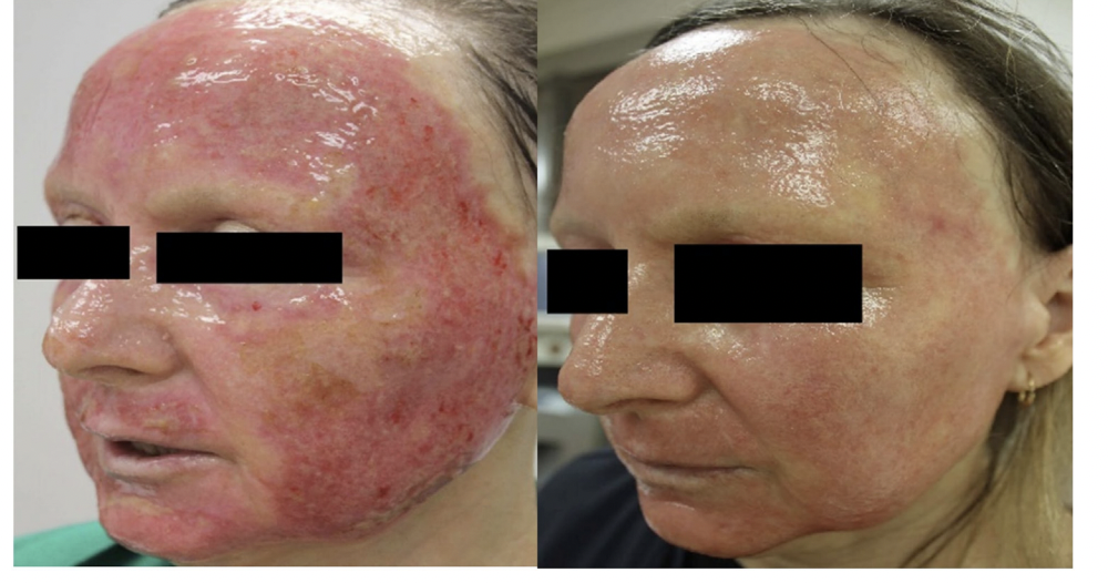 Ablative laser resurfacing deals